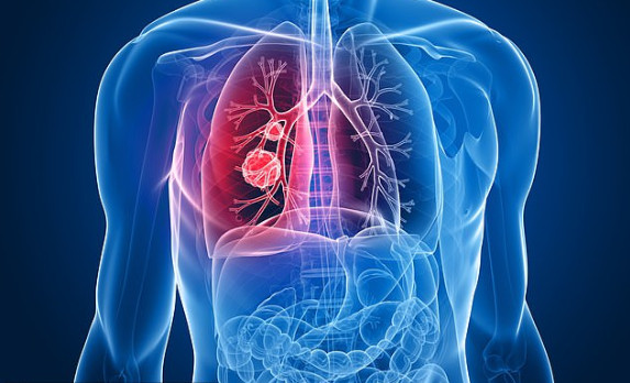 Bác sĩ: 4 dấu hiệu ngay khi thức dậy cảnh báo ung thư phổi - Ảnh 1.