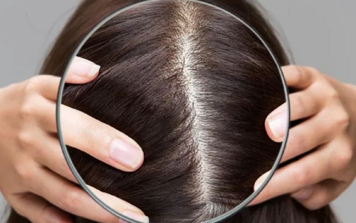 5 cách trị rụng tóc hói đầu đơn giản ngay tại nhà
